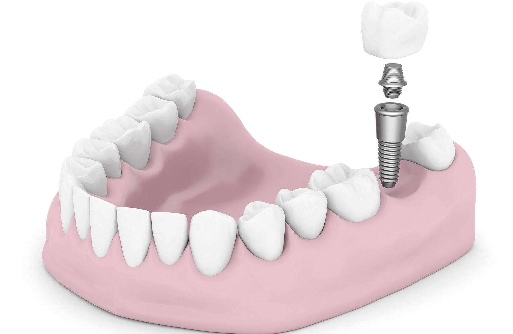 Dental Implants and Bridges | Dentist