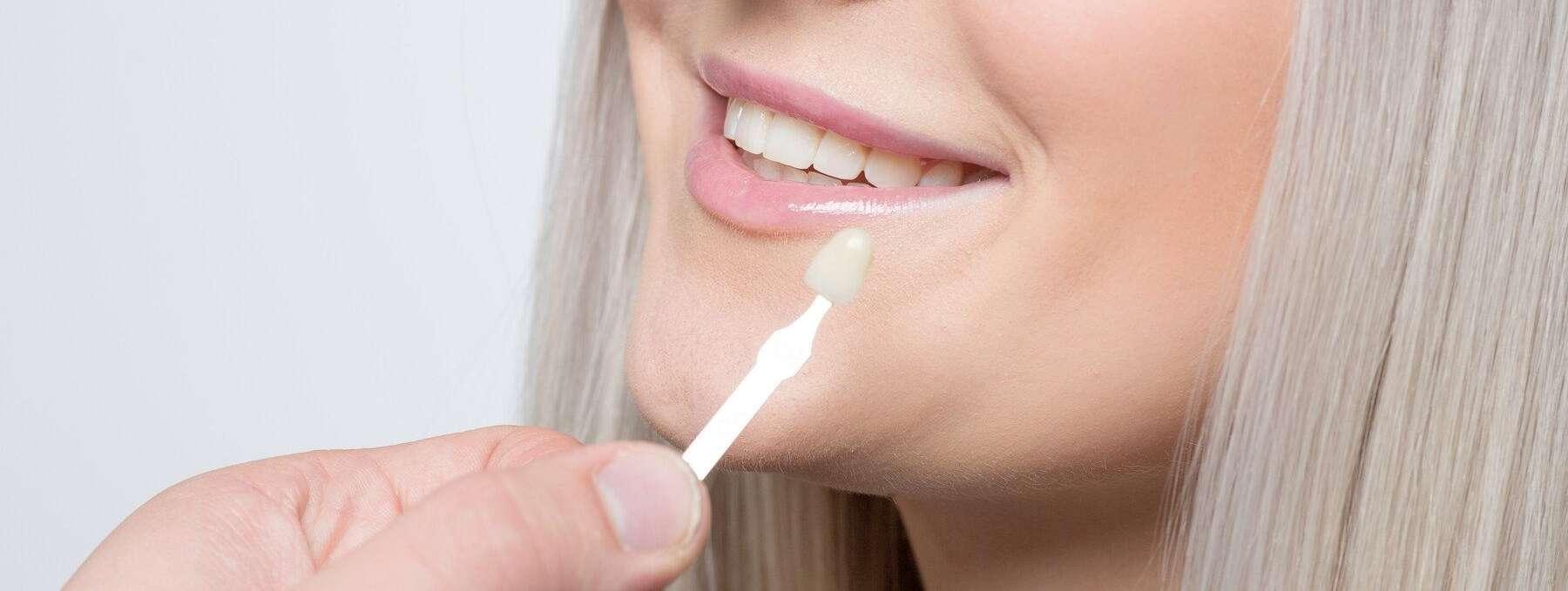 Veneers | Dentist
